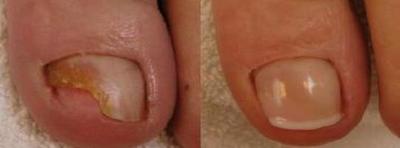 Repareren van schimmelnagels voor de zomer