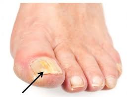 “Help, ik heb een rotte nagel”