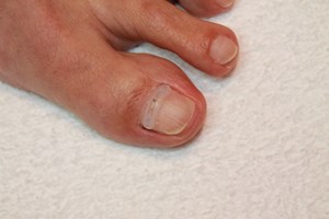 Foto nagelbeugeltechniek